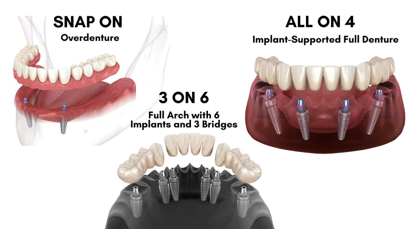Comparison of Snap-On dentures, All-on-4, and 3-on-6 dental implant solutions – full arch restoration optionsComparison of Snap-On dentures, All-on-4, and 3-on-6 dental implant solutions – full arch restoration options